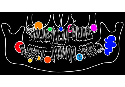 Розпізнавання не злоякісних новоутворень в стоматології з використанням КПКТ