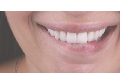 Дві сторони однієї посмішки: прямі та непрямі реставрації. Вибір лікаря стоматолога  без компромісів у  пошуках досконалості.